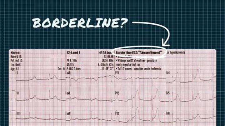 What is borderline ECG on EKG?