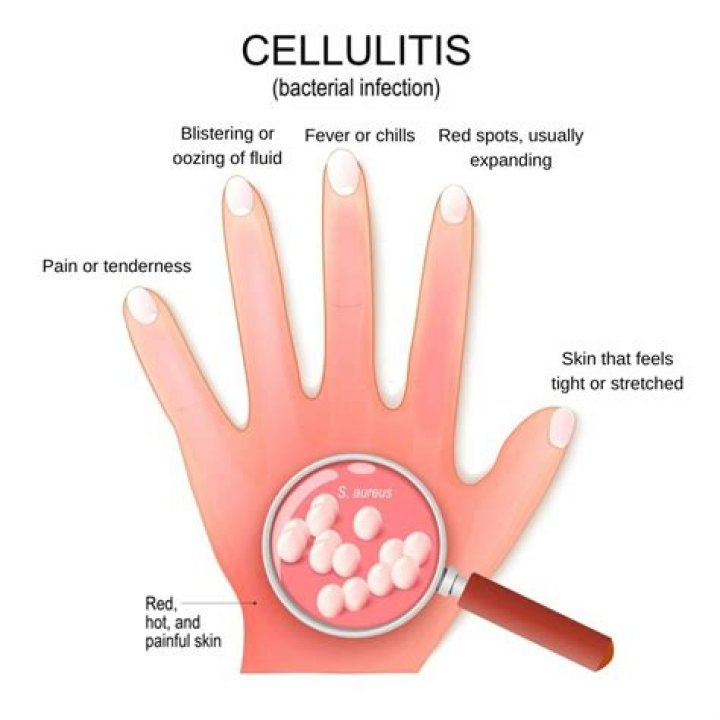 What is cellulitis of the trunk?