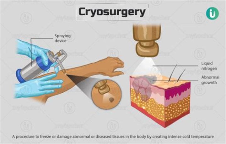 What is cryosurgery used for?