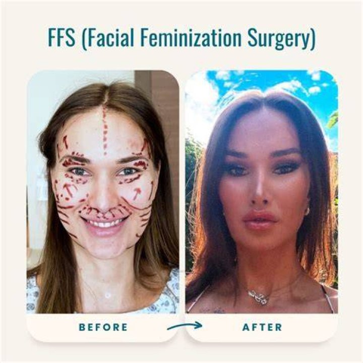 What is done in facial feminization surgery?