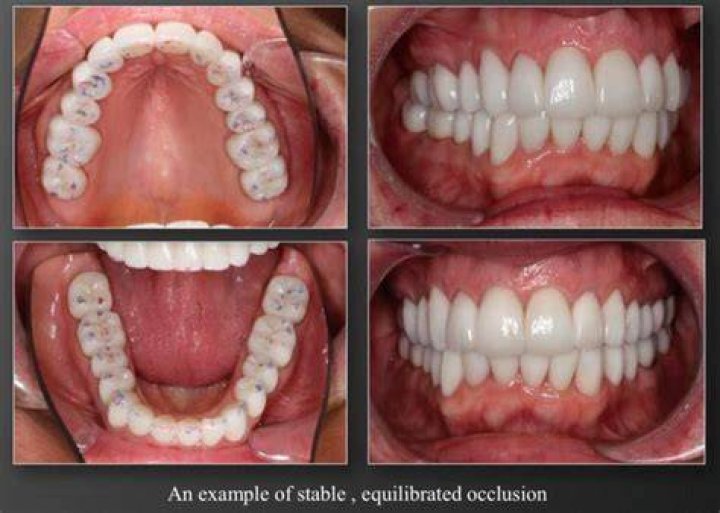 What is duct tape occlusion?