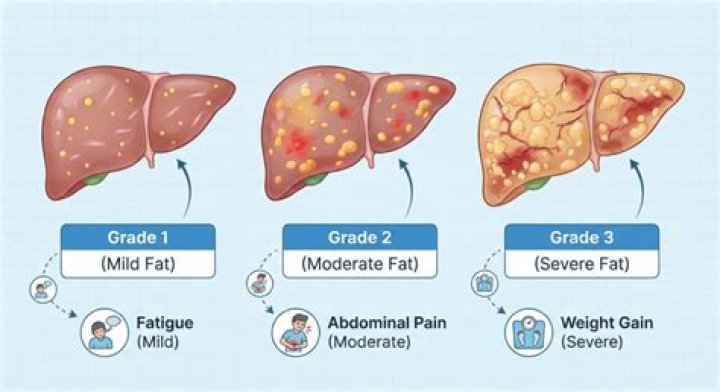What is fatty liver type 2?