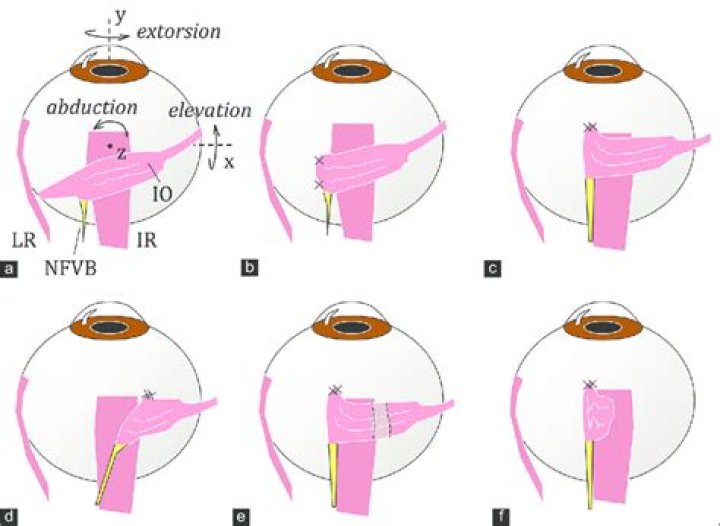 What is inferior oblique myectomy?
