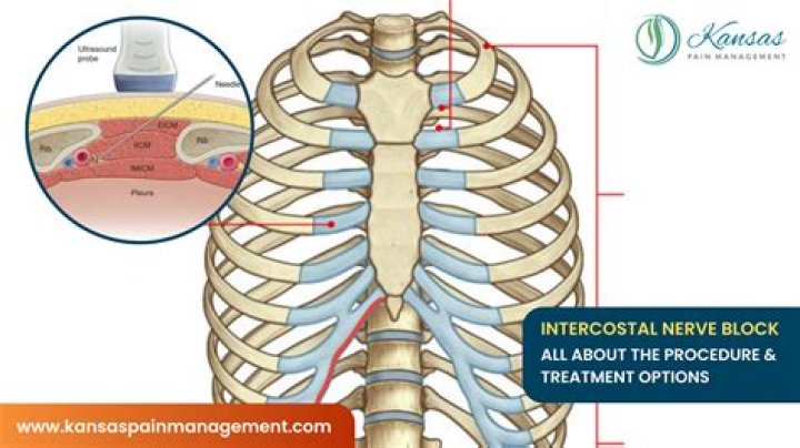 What is intercostal pain? | ContextResponse.com