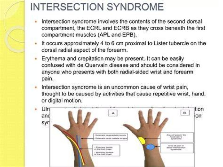 What is intersection syndrome? | ContextResponse.com