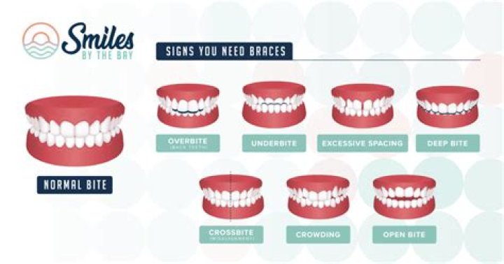 What is it called when your bottom teeth go over your top teeth?