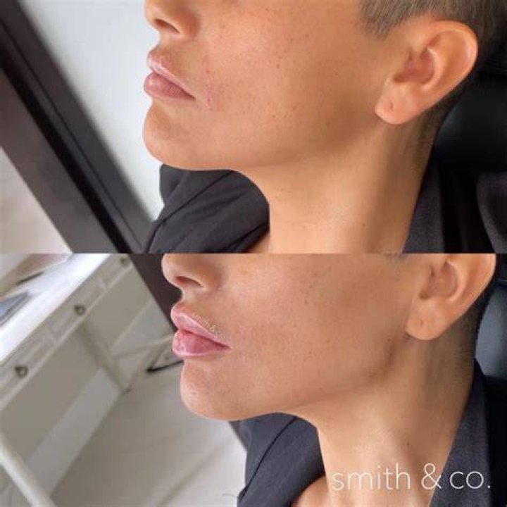 What is jawline slimming?