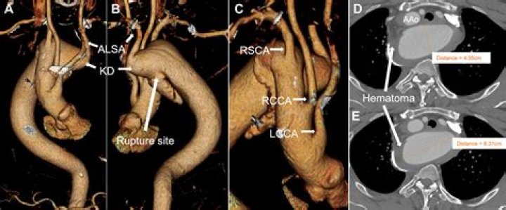 What is Kommerell diverticulum? | ContextResponse.com