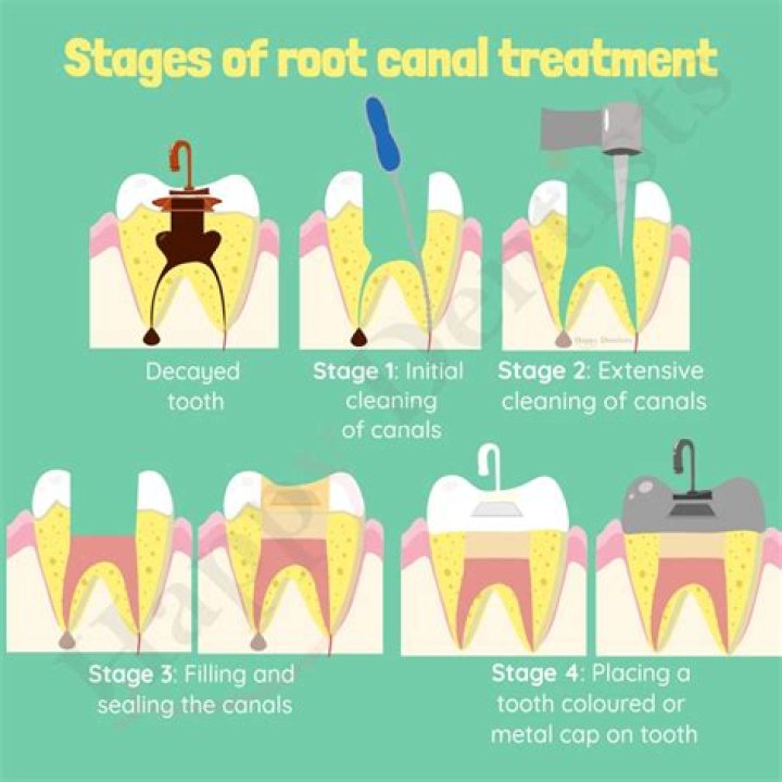 What is meant by root canal?