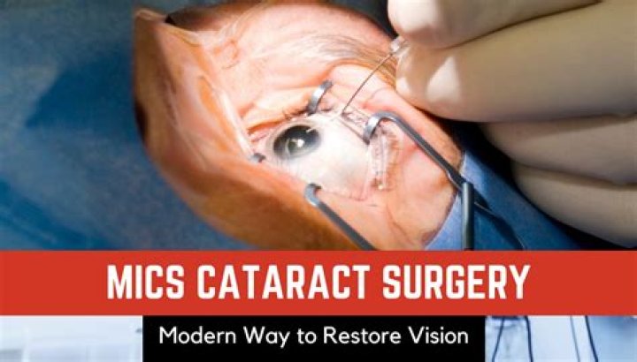 What is MICS cataract surgery?