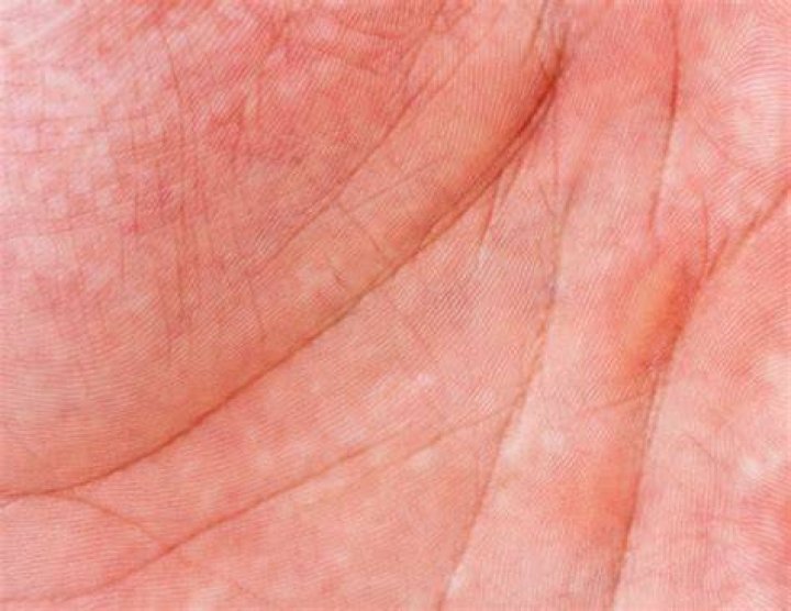 What is mottled skin a sign of?