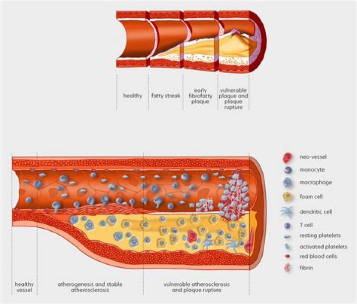What is one key way to reduce the risk of atherosclerosis quizlet?