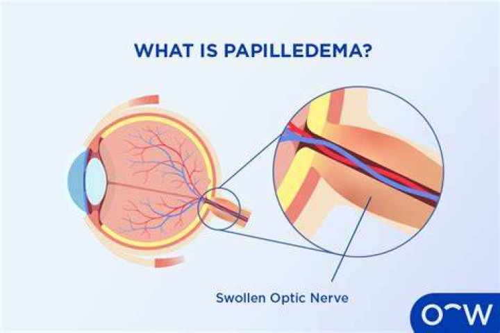 What is Papilledema mean? | ContextResponse.com