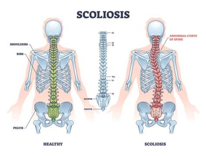 What is scoliosis of the lumbar spine?