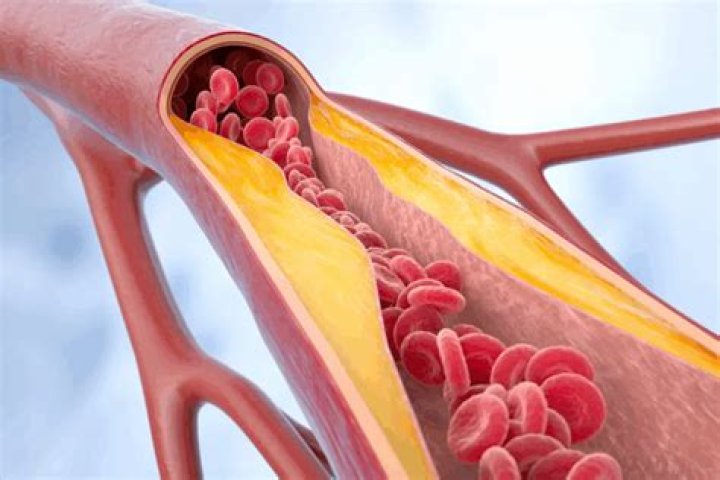 What is the abnormal hardening of the walls of an artery or arteries?