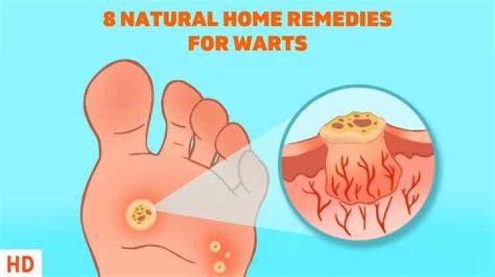 What is the best natural remedy for warts?