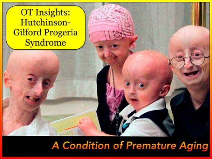 What is the current status of research on progeria?