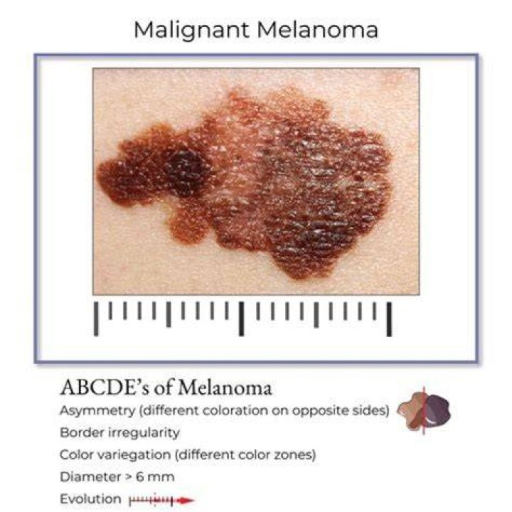 What is the definition of malignant melanoma?