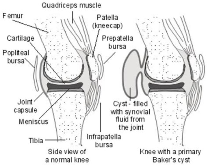 What is the difference between a bursa and a cyst?