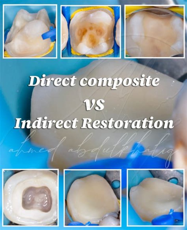What is the difference between direct and indirect restorative materials?
