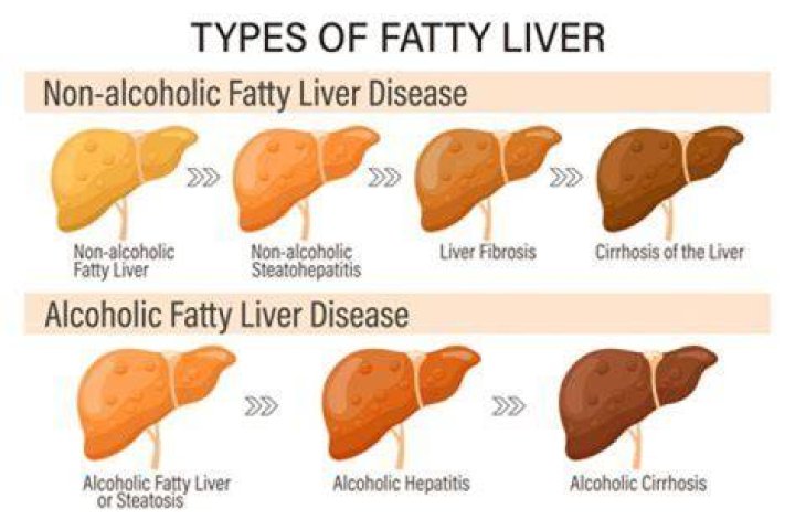 What is the difference between fatty liver and NASH?