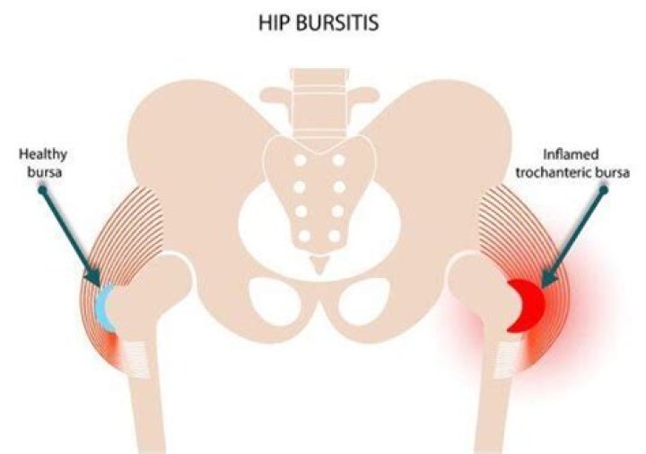 What is the fastest way to get rid of hip bursitis?