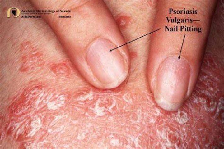 What is the meaning of psoriasis vulgaris?