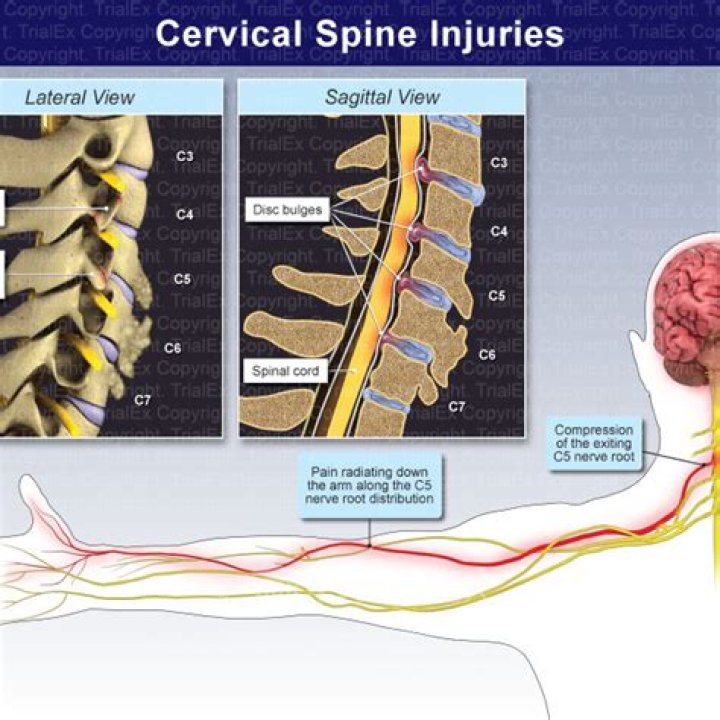 What is the most common mechanism of injury for severe cervical spine injuries?