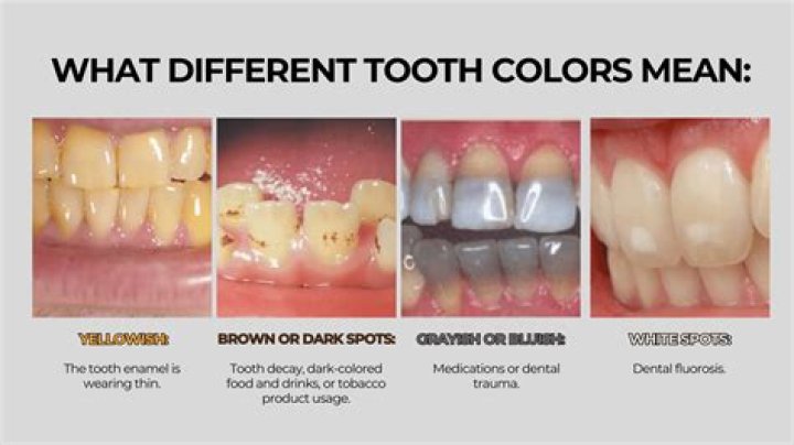 What is the natural tooth color?