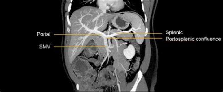 What is the portal splenic confluence?