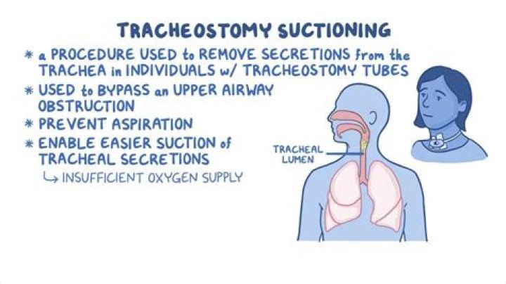What is the protocol for NT suction?