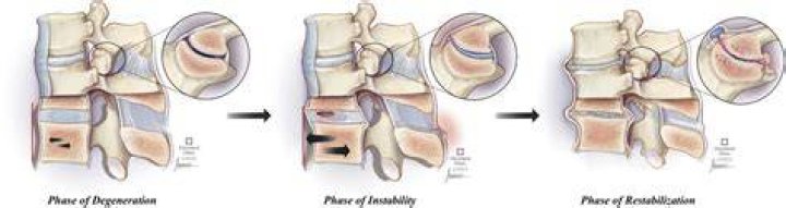 What is the treatment for degenerative spondylolisthesis?