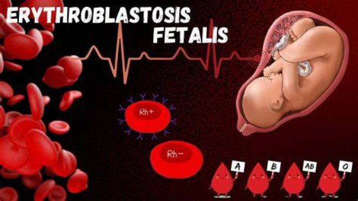 What is the treatment for Erythroblastosis Fetalis?