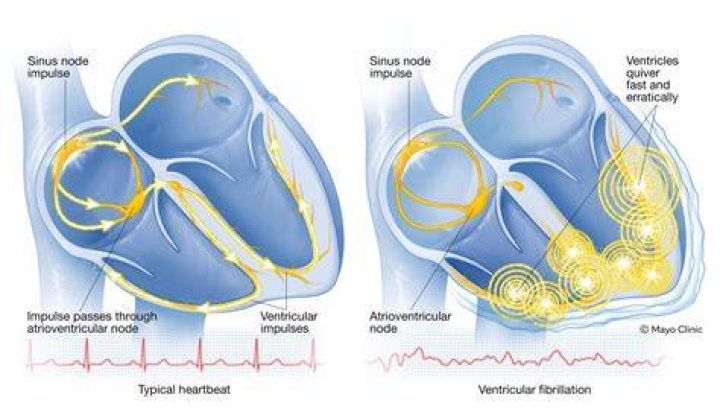 What is ventricular stiffness? | ContextResponse.com