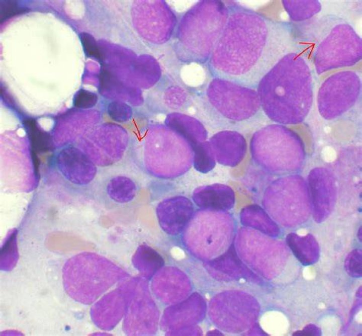 What leukemia has Auer rods?