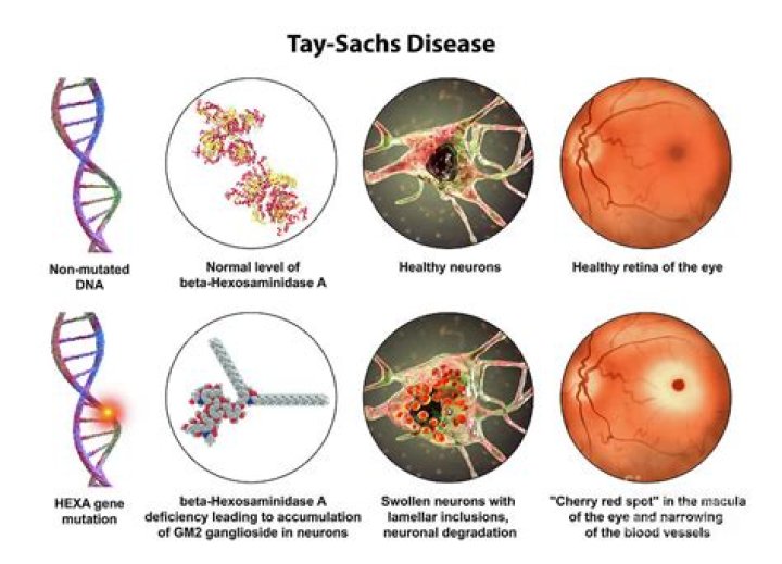 What organelle is affected by Tay Sachs disease?