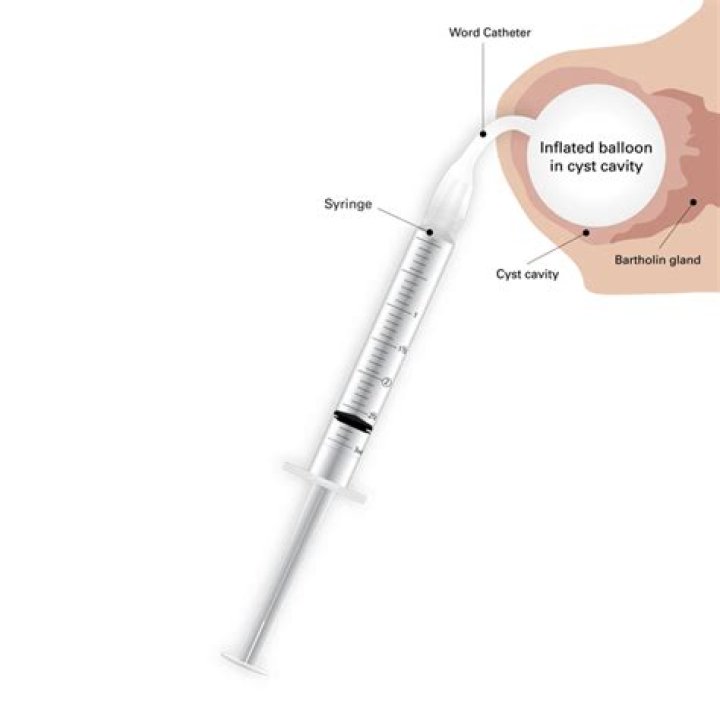 Where does the word catheter come from?