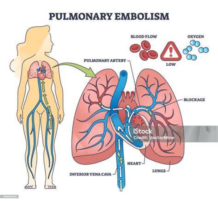 Which of the following is a common source of pulmonary embolism?