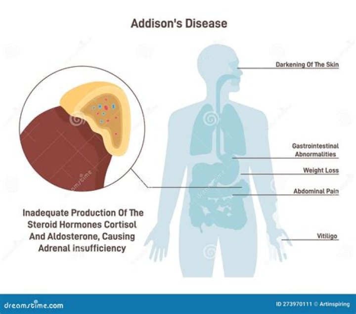 Who is at risk for Addison's disease?