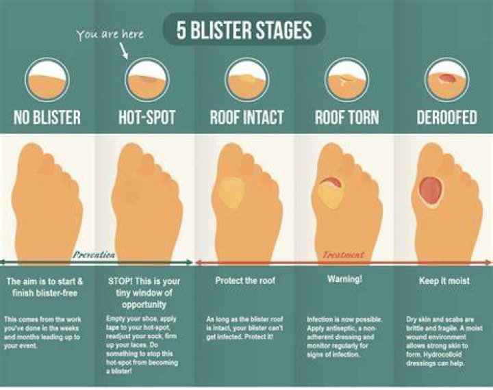 Why do I have blisters on my toes?