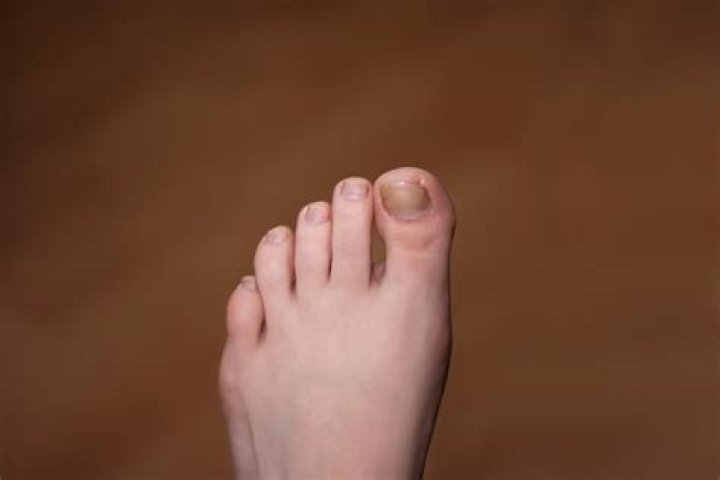 Why do I keep getting ingrown toenails?