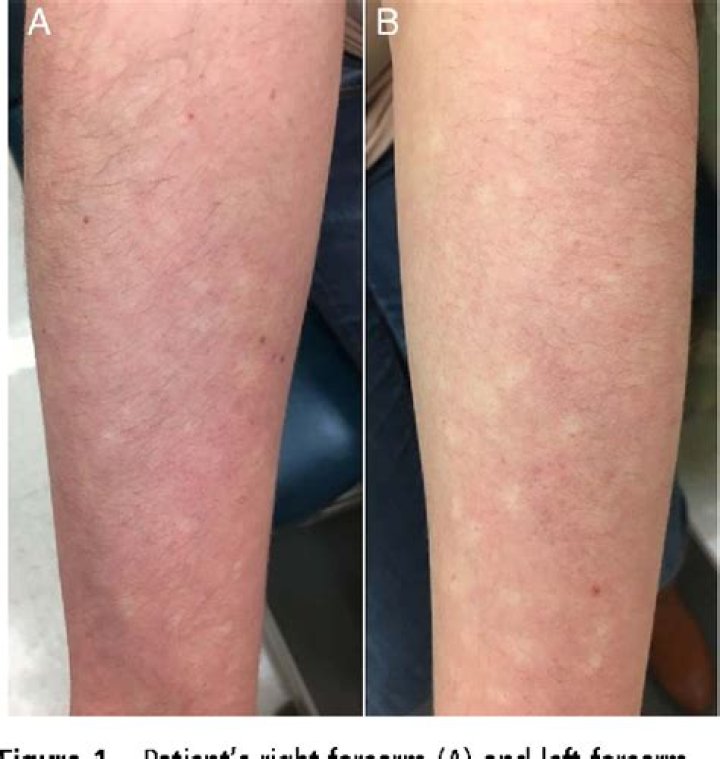 Why do my legs get blotchy?
