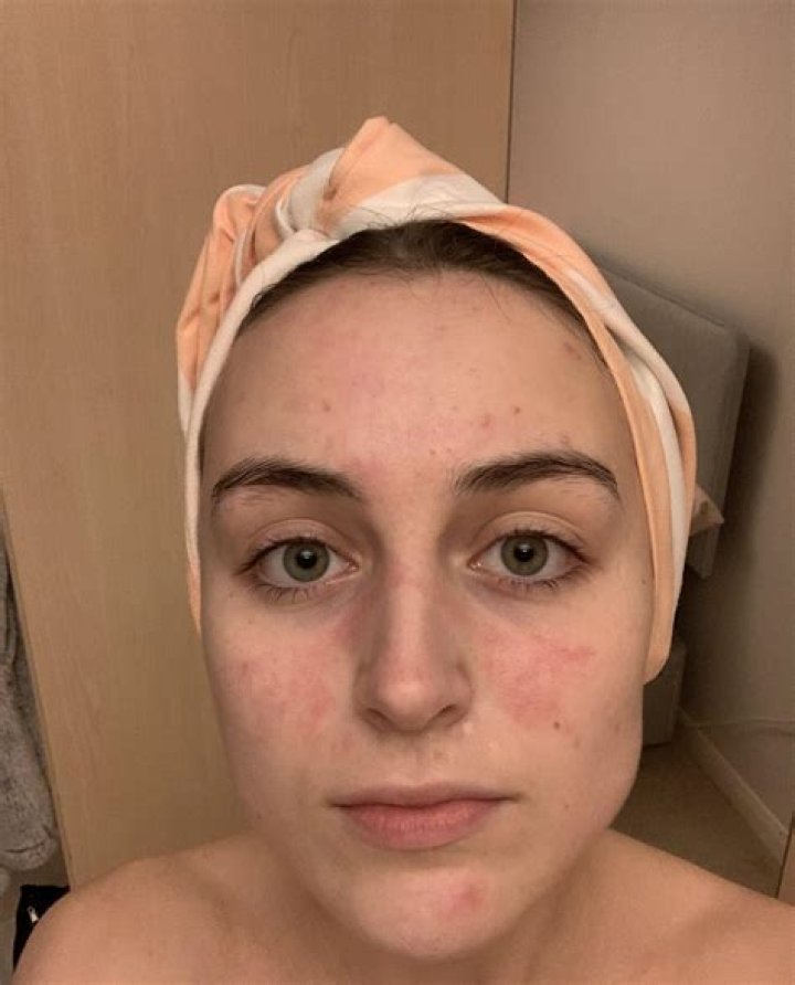 Why is my face dry after a shower?