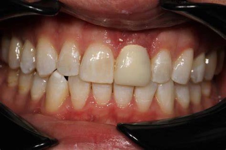 Why is my tooth black after a filling?
