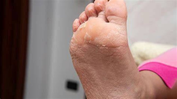 Why is the skin peeling off my feet?
