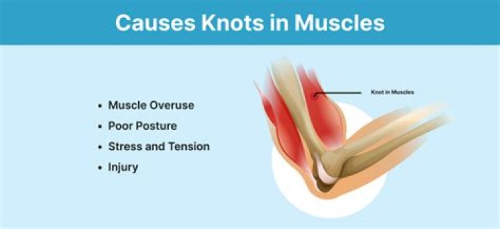 Will a muscle knot go away?