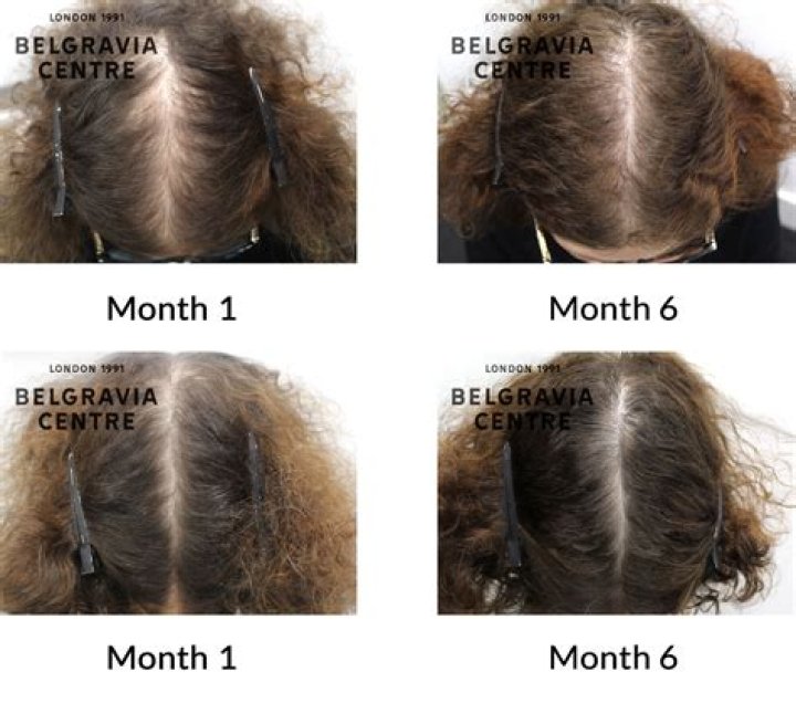 Will my hair grow back after a weave?