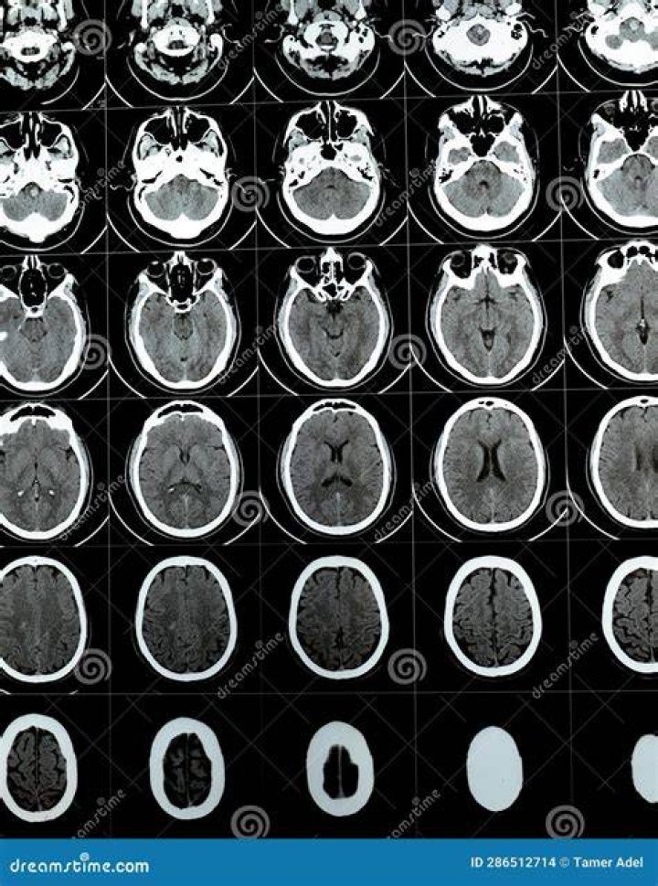 Will TMJ show on CT scan?
